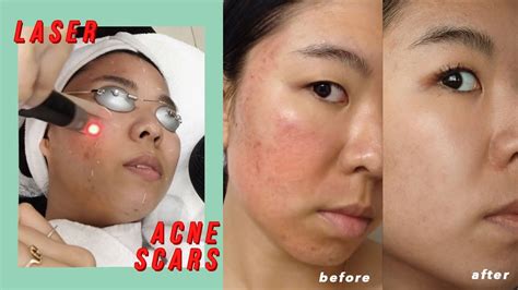 Picosure Laser For Acne Scars And Hyperpigmentation Before And After Youtube
