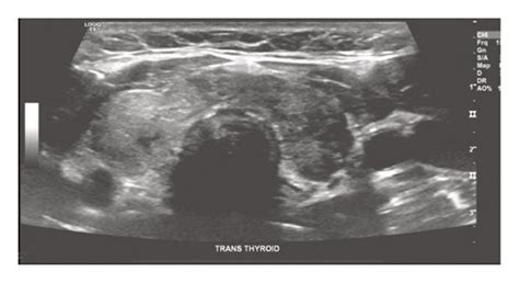 Ultrasound Of The Thyroid Gland Showing A Heterogeneously Enlarged