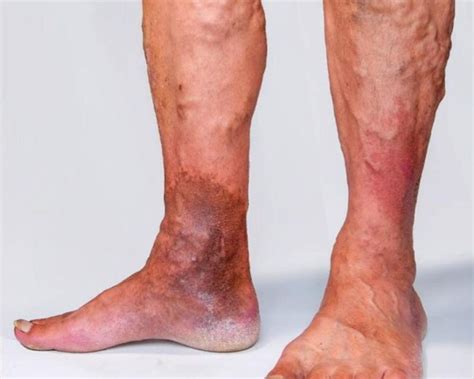 Recognizing And Treating Bursting Varicose Veins Vein Center In