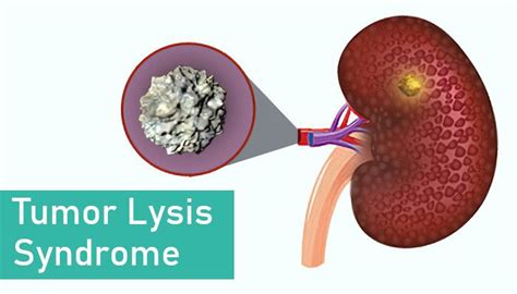 Signs Of Tumor Lysis Syndrome