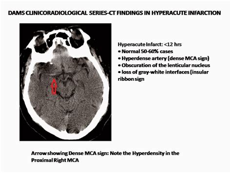Dense Mca Sign Hyperacute Infarction Sumers Radiology Blog
