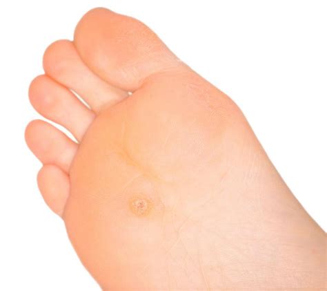 What Are Callus Pads With Pictures