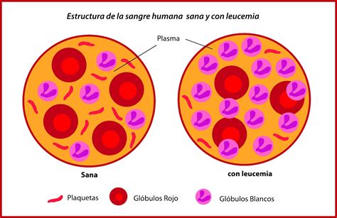 Leucemia Clasificación
