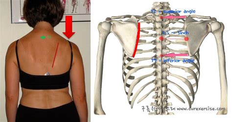 How To Truly Identify And Treat Thoracic Outlet Syndrome TOS MSK