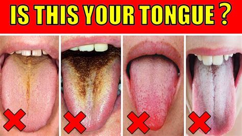 What Your Tongue Reveals About Your Health YouTube