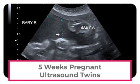 5 Week Pregnancy Symptoms Twins Pregnancywalls