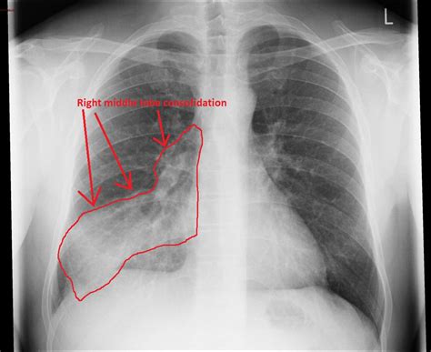 Pneumonia Chest X Ray Diagnosis
