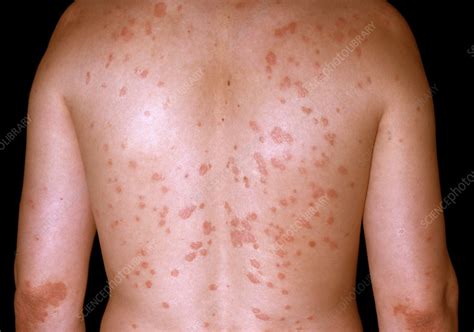 Guttate Psoriasis Stock Image C0500831 Science Photo Library