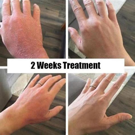 Tib Herbal Antibacterial Cream Psoriasis Cream Anti Itch Relief Eczema