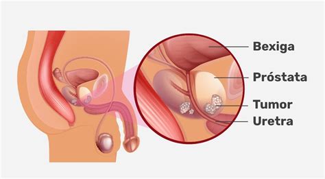 Cirurgia de próstata o que é como é feita tipos e recuperação Seja Saudável