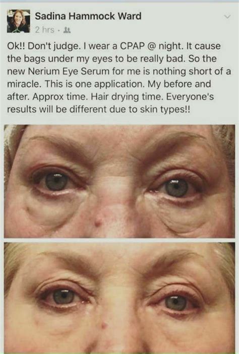 Lose The Puffy Allergy Eye Look With Nerium Eye Serum Face Wrinkles