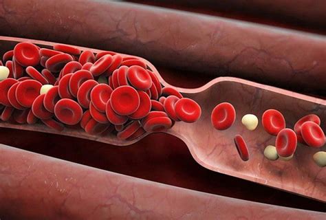 Formation And Prevention Of Blood Clots In Cancer Patients Vinmec