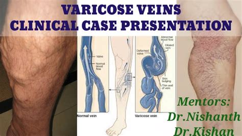 Varicose Veins Clinical Case Presentation Youtube