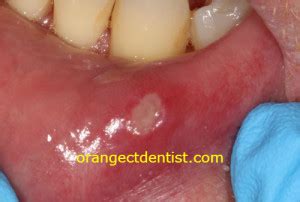 Aphthous Ulcers Canker Sores Dentist Orange Woodbridge Ct