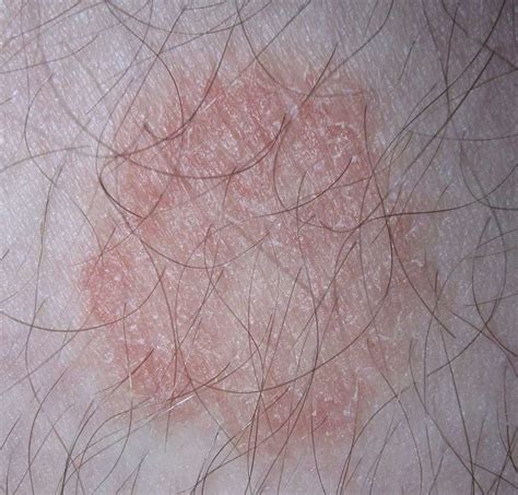 Fungal Skin Infection Tinea Corporis Cruris Pedis Capitis
