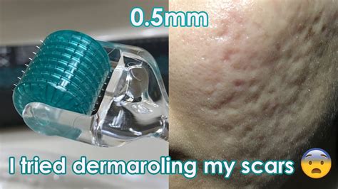 I Tried Dermarolling My Acne Scars Demo Review Youtube