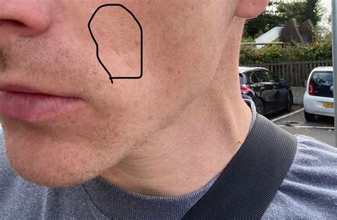 So My Partner Recently Noticed These Spots On Their Neck Which Is Not