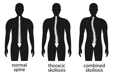 Vector Illustration Of Spinal Deformity Kyphosis Lordosis And