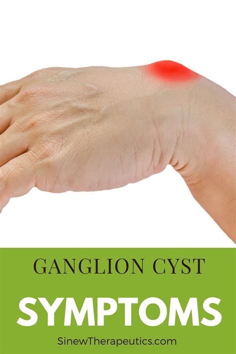10 Home Remedies To Get Rid Of Ganglion Cysts Causes And Medical