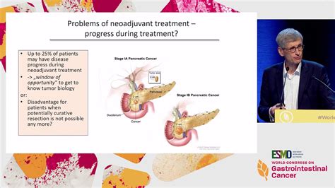 Debate Treatment For Resectable Pancreatic Cancer Neo Adjuvant