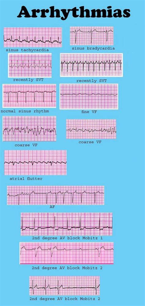 Ekg Interpretation Cheat Sheet Heart Arrhythmias Guide 2020 Update