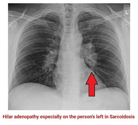 Bihilar Lymphadenopathy In Sarcoidosis X Ray Radiology Imaging