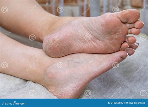 Problematic Diabetic Foot In A Woman Dry Feet And Cracked Heels Of A