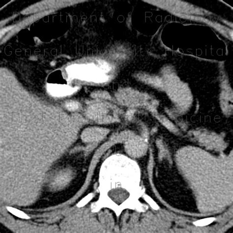 Radiology Case Choledocholithiasis Gallstones Mrcp