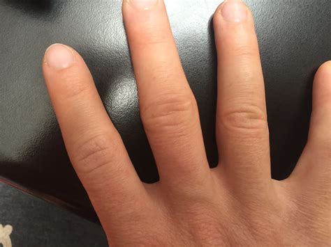 Index Finger Is Quite Swollen Reduced In This 35 Months Rest