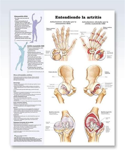 Entendiendo La Artritis Anatomy Poster Rheumatoid Arthritis
