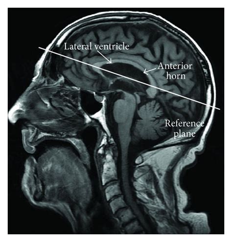 A Sagittal T1 Weighted Image Showing The Reference Plane Intersecting