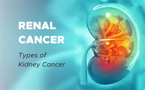 Renal Cancer Types Of Kidney Cancer Endogynecology