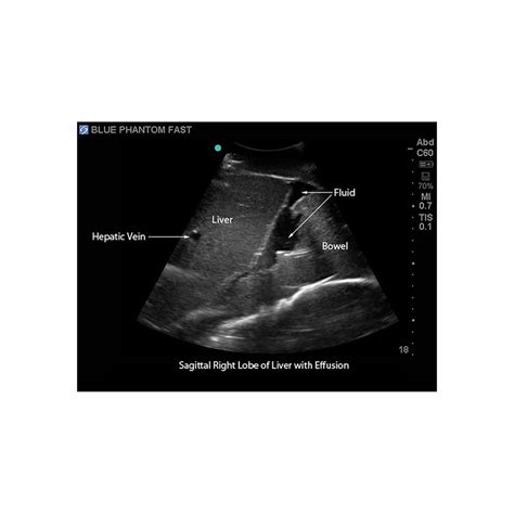 Fast Exam Ultrasound Training Model