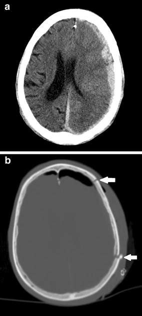 Ct Images From A Large Subdural Hematoma Sdh With Midline Shift A