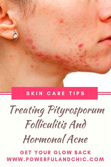 How To Treat Folliculitis With Essential Oils