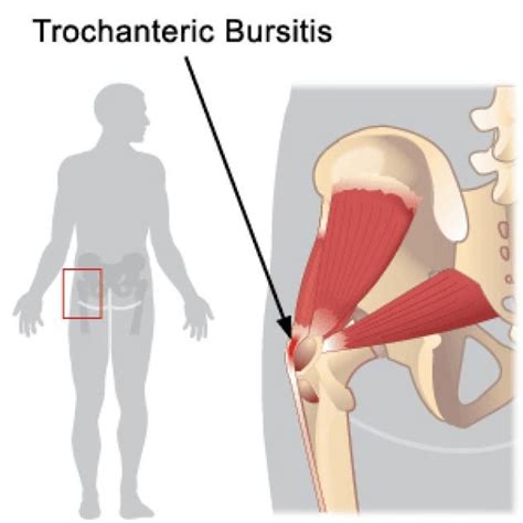 Trochanteric Bursitis A Bursa Is A Fluid Filled Sack That Decreases