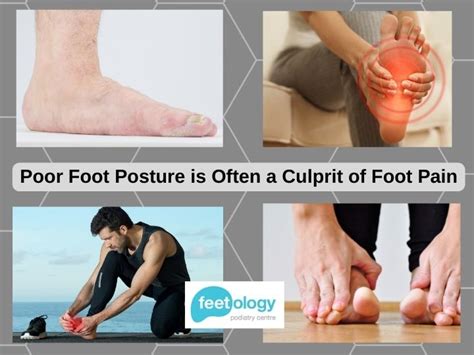 Foot Posture The Surprising Link That Can Cause Foot Pain Feetology