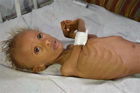 ravaged by conflict yemen s coast faces rising malnutrition breitbart