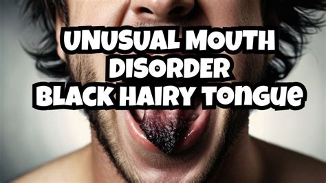 Do You Know What Is Black Hairy Tongue Its Causes Symptoms Differential Diagnosis And