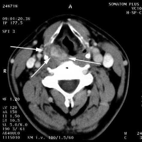 Endoscopic View Of The Inflammatory Pseudotumor In The Right Sinus