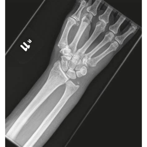 A Pa X Ray Right Wrist B Lateral X Ray Right Wrist C T1 Coronal