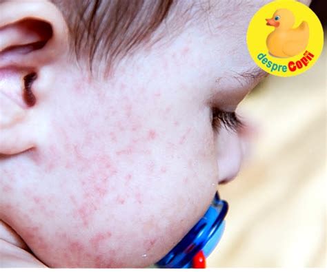 Poze Blog Poze Alergii Copii