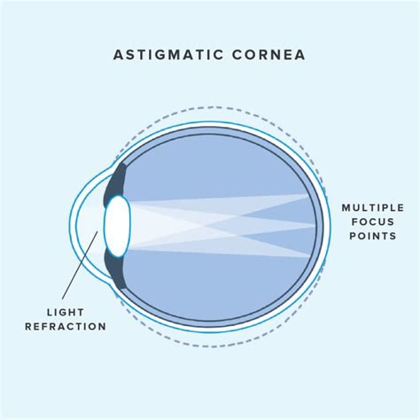 What Is Astigmatism And Can It Be Corrected Warby Parker
