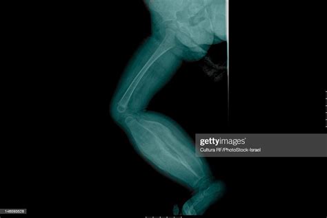Xray Of Infantile Cortical Hyperostosis High Res Stock Photo Getty Images