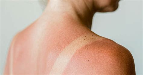 Sun Rash Poisoning Allergy Treatment Causes Pictures And More
