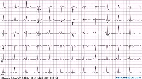 Understanding An Ecg Geeky Medics