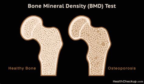 Bone Mineral Density Test For Osteoporosis Signssymptoms Of Osteoporosis