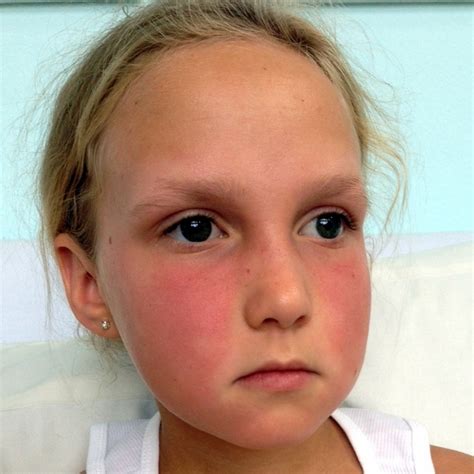 Leave it on overnight or for at least 30 minutes before washing it off. Rash On Face Due To Food Allergy - Food Ideas