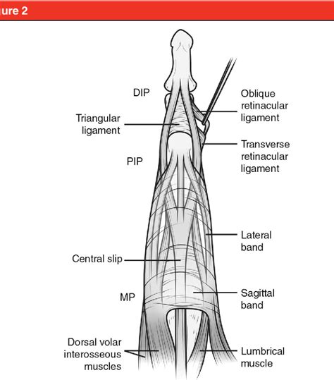 Figure 3 From Closed Sagittal Band Injury Of The Metacarpophalangeal