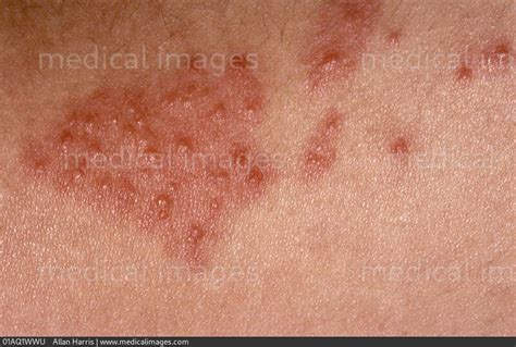 Stock Image Dermatology Insect Bites A Cluster Of Small Red Raised